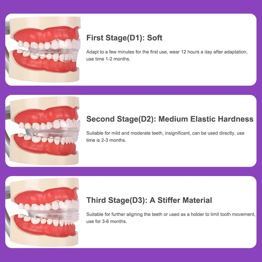 Appareil dentaire, accolades orthodontiques, entraîneur de dents, entraîneur d'alignement, embout po