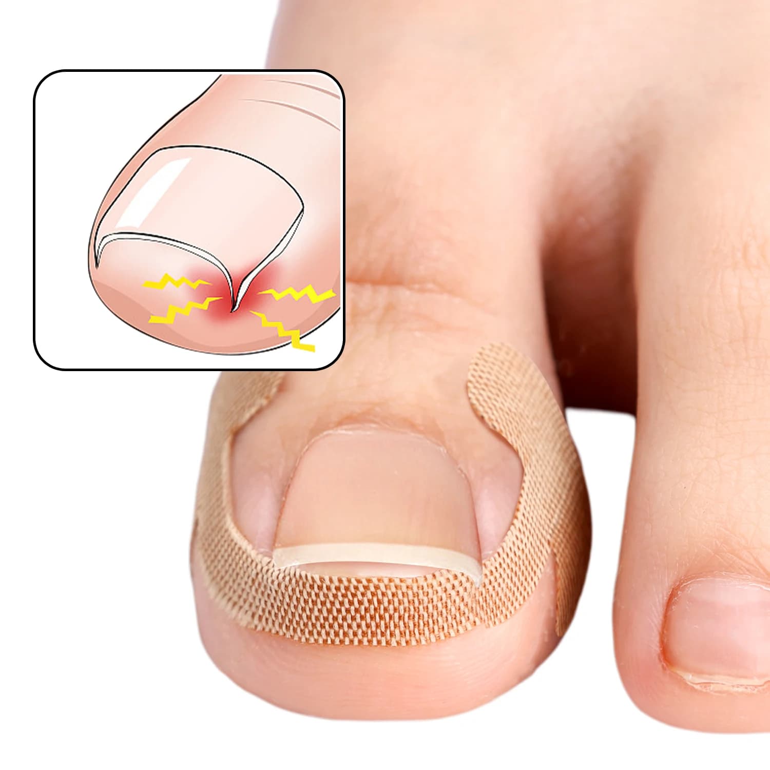 Bandes correctrices pour ongles incarnés, 100 pièces, adhérence durable, autocollants imperméables, 