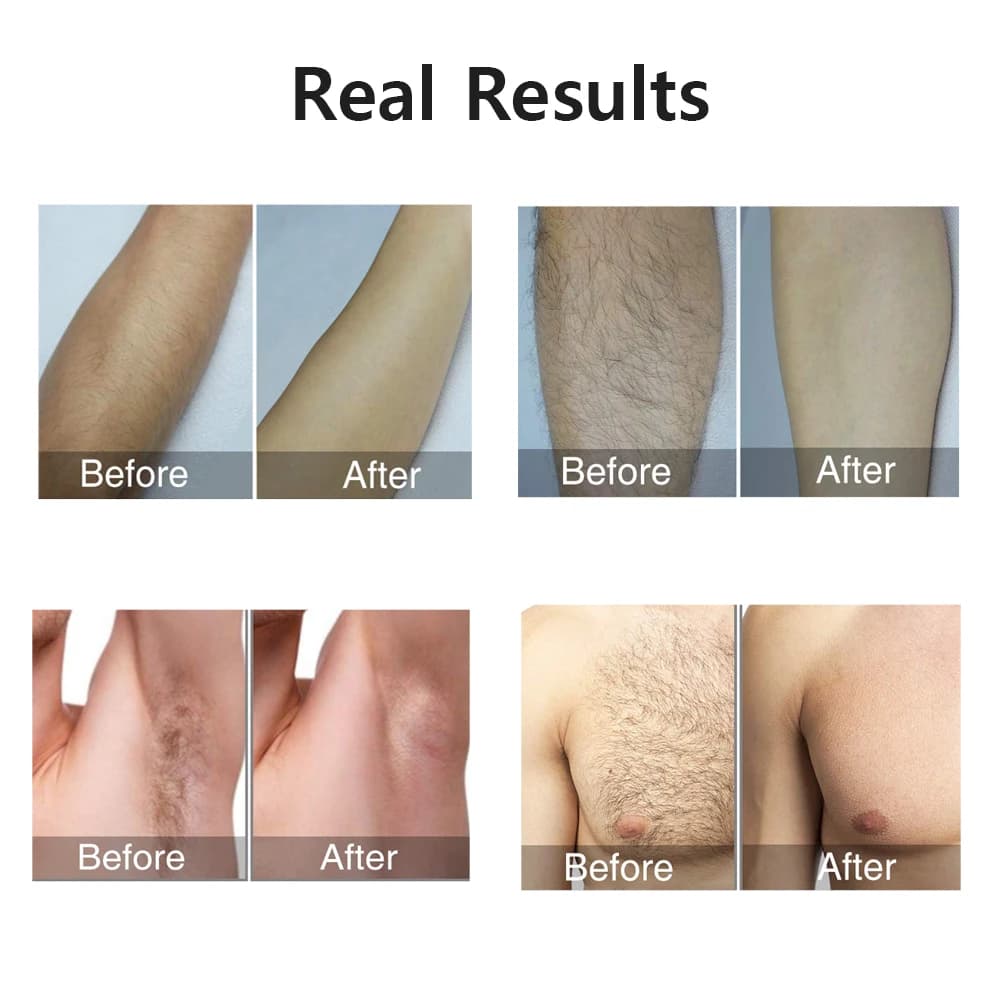 Depilador a laser ipl, remoção de pelos para mulheres, biquíni corporal, facial, 990000 flashes, per
